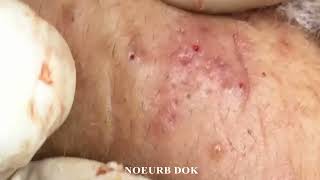 Popping Tons Of Blackheads Part 175