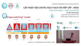 Cập nhật hội chứng nguy kịch hô hấp cấp (ARDS) #4- Thông khí nằm sấp trong ARDS