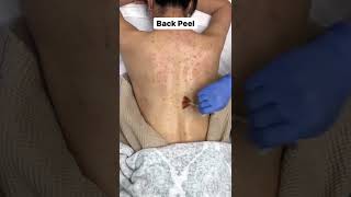 Get the Perfect Back Peel at Ellemes Medical Spa in Atlanta