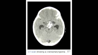 Craniopharyngioma - Derived from remnants of Rathke's Pouch.