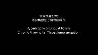 舌扁桃腺肥大 慢性咽喉炎 喉嚨異物感 lingual tonsil hypertrophy chronic pharyngitis