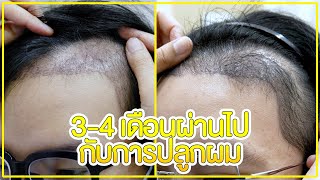 3-4 เดือนผ่านไปกับการปลูกผม