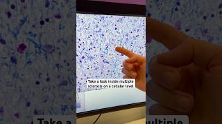 In The Lab: Zooming in on Multiple Sclerosis