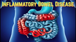 Inflammatory Bowel Disease (updated 2021) - CRASH! Medical Review Series