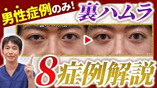 【クマ治療】男性の裏ハムラについて8症例解説！クマ取りの種類から適応、男性と女性のクマ治療の違いについてを網羅的に解説します！【目の下のクマ取り/ 整形 /ハムラ】