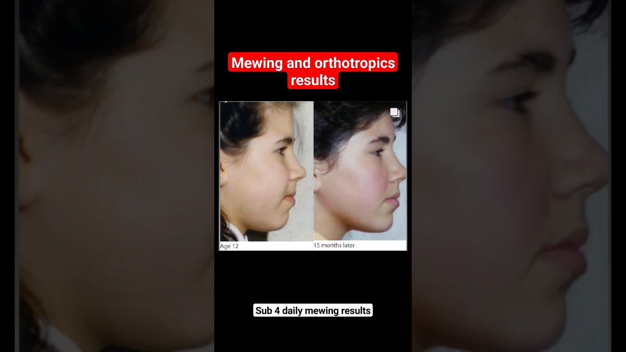 Mewing And Orthotropics Results 😑 - YouTube