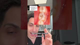 Can cavities reverse