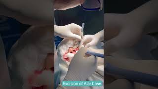 Alar Base Reduction | Alarplasty | মোটা নাক চিকন করার উপায় | Rhinoplasty in Bangladesh