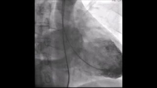 Seller's grade  III mitral regurgitation