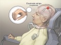 Implanted Brain–Computer Interface in a Locked-In Patient