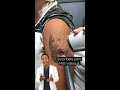 eliminación de tatuaje con láser dr. suárez collado