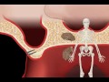 alveolar atrophy alveolar ridge augmentation