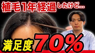 【植毛1年経過】おでこを狭くした25歳の青年が衝撃の決断を発表！？