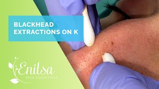 Blackhead Extractions on K - Merry Christmas!