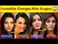 20 Turkish Actresses Before and After Surgery 😮, Plastic Surgery, Turkish Drama
