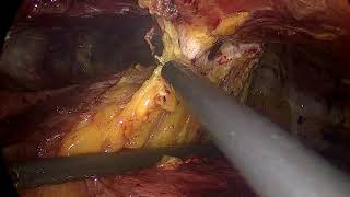 eTEP R-S Tips and Tricks, dissecting and suturing the anterior abdominal wall. Dr Hector Valenzuela