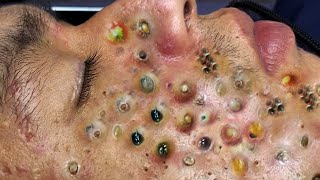 Blackheads Removal | Acne Treatment and Very Satisfying Satisfying Pimple pop #blackheads