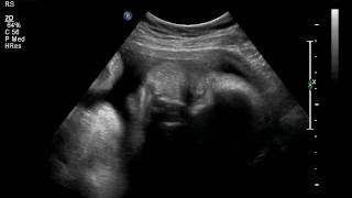 little billy ultrasound 34 weeks 012