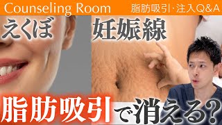 脂肪吸引で一体どうなる？消したい妊娠線、消したくないえくぼ？【Dr.吉江 脂肪吸引カウンセリングルーム】