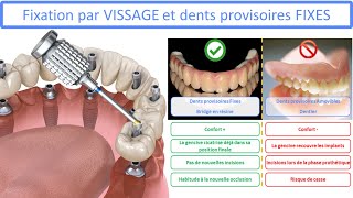 All on 4 - Fixation par vissage et dents provisoires fixes