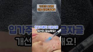 입가주름이 자글자글해서 나이들어 보여요! 입가주름도 해결할 수 있나요?