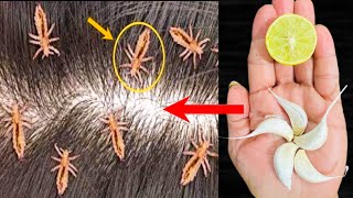 सिर्फ़ 10 मिनट बालों में लगालो सिर की सारी जुएं हमेशा के लिए ख़त्म हो जाएंगी Lice Removal