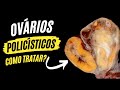 Ovários Policísticos: Sintomas, Diagnóstico e Tratamento