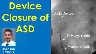 Device Closure of Atrial Septal Defect ASD