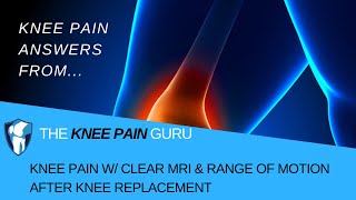 Knee Pain w/ Clear MRI, Knee Cupping & ROM AFTER Knee Replacement by The Knee Pain Guru #KneeClub