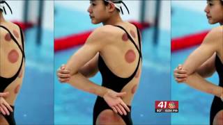 Massage Therapist Explains Cupping