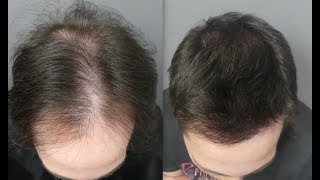 3601 Grafts. HT by FUE Technique. Early regrowth at 6 months. Injertocapilar.com.1903/2017