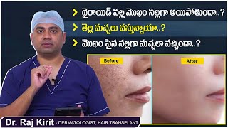 తెల్ల మచ్చలు వస్తున్నాయా? || What Causes White Spots on Face? || Celestee Skin And Hair Clinic