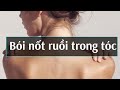 Nốt ruồi trong tóc Đàn ông, Phụ nữ có ý nghĩa gì?