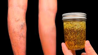 Incredible! Get rid of varicose veins forever! This treasure should be in every home