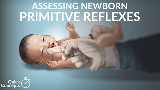 Assessing Newborn Primitive Reflexes by N. Gold | OPENPediatrics