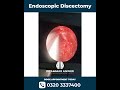 percutanous endoscopic disc surgery endoscopic discectomy neurosurgeon dr ammar anwer