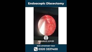 Percutanous Endoscopic disc Surgery | Endoscopic Discectomy | Neurosurgeon Dr Ammar Anwer