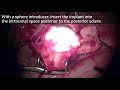 bioceramic orbital implant evisceration procedure exclusive fci orbital