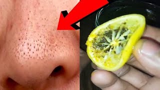 Remove Blackheads Naturally At Home | Get Rid Of Blackheads, Whiteheads, Open Pores at home