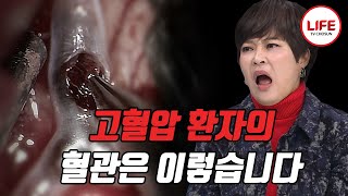 우리나라 사망 원인 2위인 심혈관질환의 주범 '쓰리고(高)' 증상이 없어 더 위험하다.