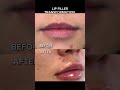 lip filler before and after