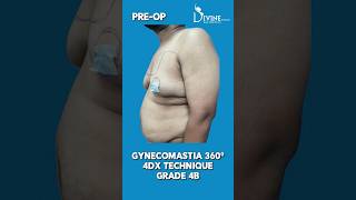 Gynecomastia Grade 4B Instant Surgery Result | Gynecomastia Surgery in Delhi #trend