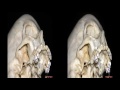 orbitozygomatic approaches 3d tv