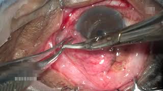 AIOC2021 - VT195 - Free conjunctival autograft in the management of mitomycin-treated unhealthy..