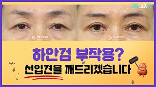 하안검 부작용? 선입견을 깨드리겠습니다