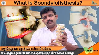 What is Spondylolisthesis? Part 1 Dr. Vignesh Pushparaj