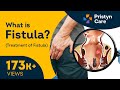 What is Fistula? | Symptoms & Treatment of Fistula