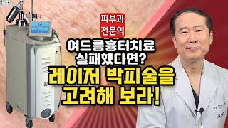 여드름 흉터 없애는 확실한 치료법!!!!-레이저 박피