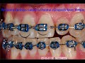 Torquing Springs-Labial vs Palatal/Lingual Root Torque