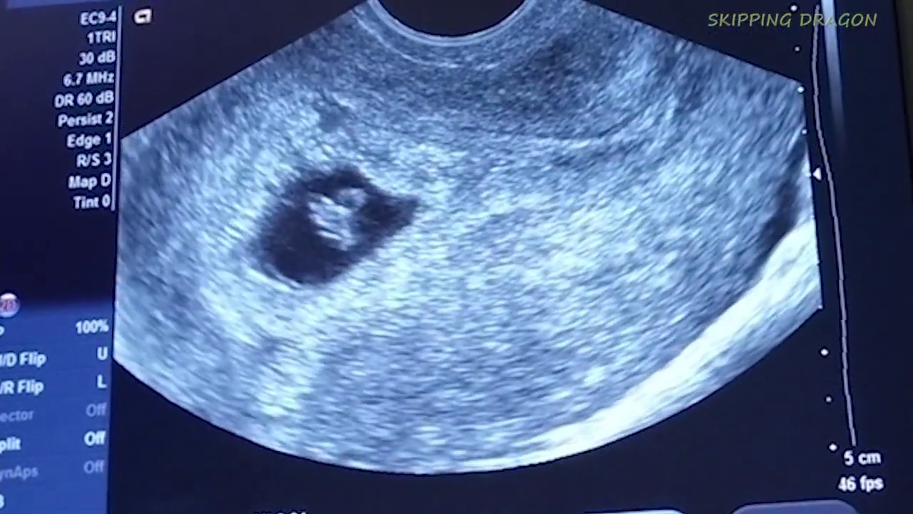 8 Week Ultrasound Photo